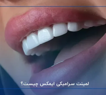 لمینت سرامیکی ایمکس چیست؟