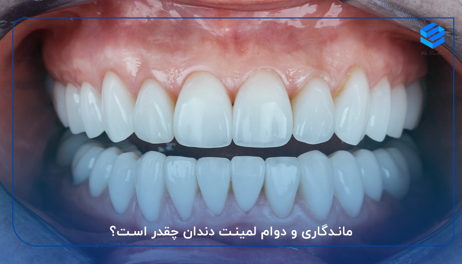 ماندگاری و دوام لمینت دندان چقدر است؟