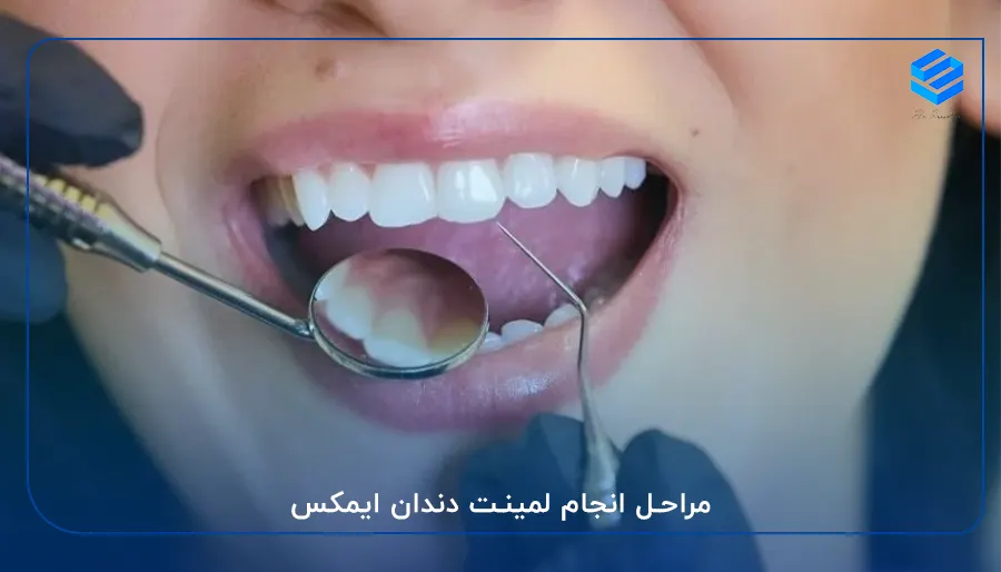 مراحل انجام لمینت دندان ایمکس