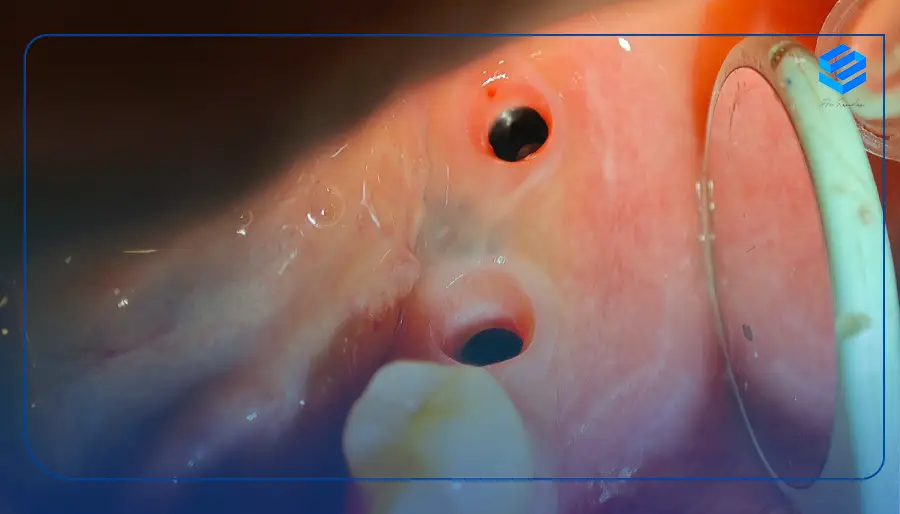 مراحل ایمپلنت دندان