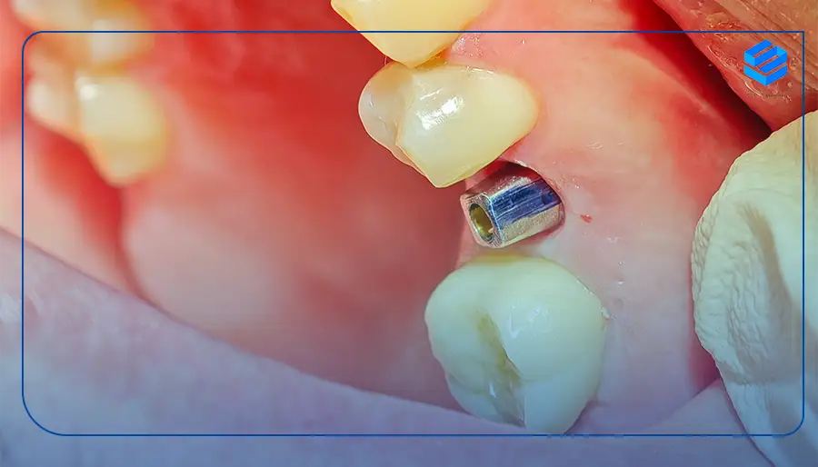 مراحل کاشت دندان در شمال تهران
