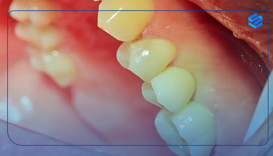 مراحل کاشت دندان در نیاوران تهران