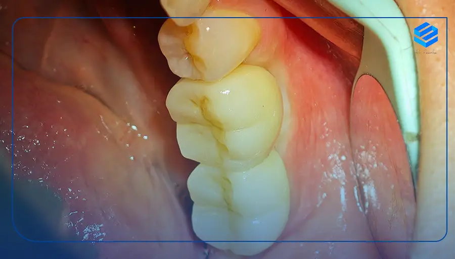 مراحل کاشت دندان در نیاوزان