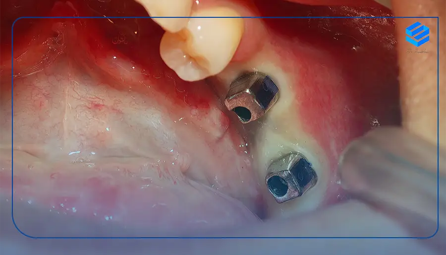 مراحل کاشت دندان