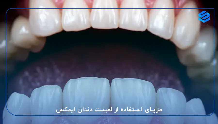 مزایای استفاده از لمینت دندان ایمکس