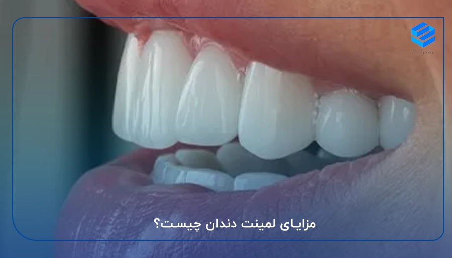 مزایای لمینت دندان چیست؟
