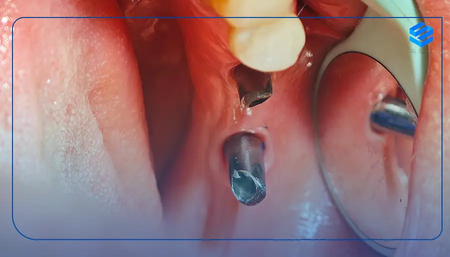 نمونه کار ایمپلنت دندان