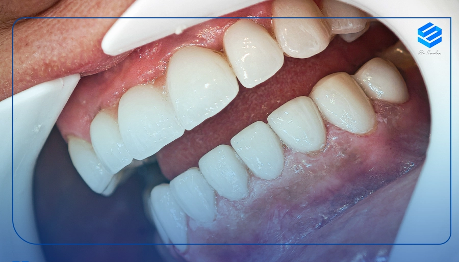 نمونه کار لمینت دندان در نیاوران