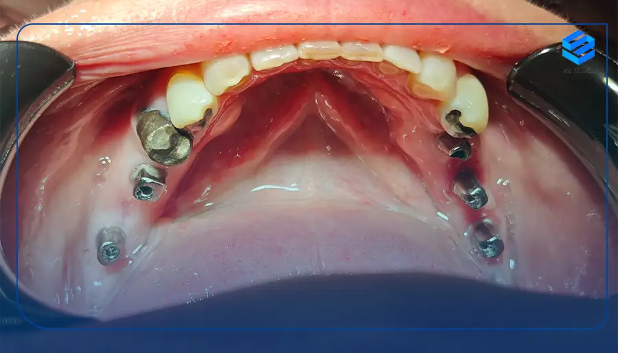 نمونه کار کاشت دندان در تهران