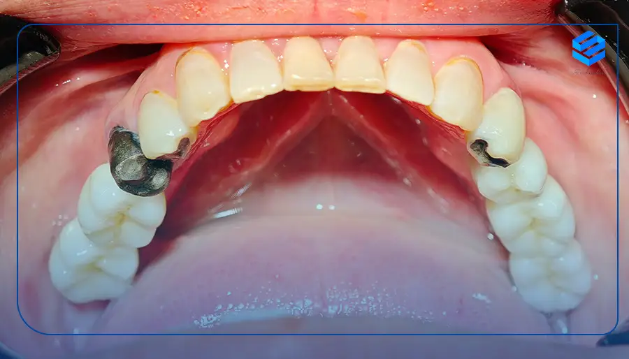 نمونه کار کاشت دندان در نیاوران