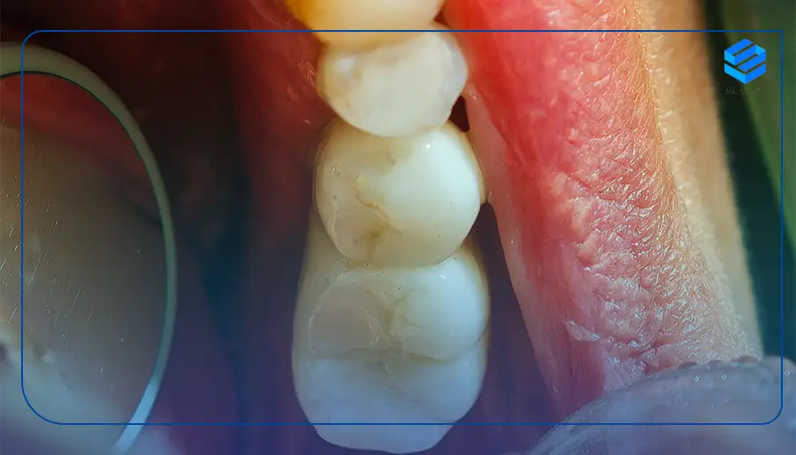 نمونه کار کاشت دندان