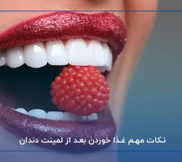 نکات مهم غذا خوردن با لمینت دندان