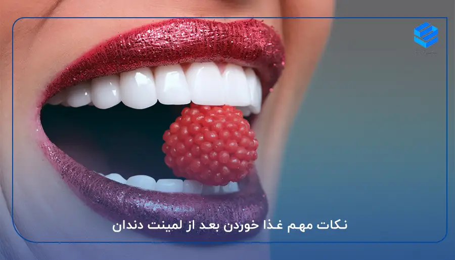 نکات مهم غذا خوردن با لمینت دندان