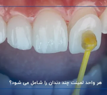 هر واحد لمینت چند دندان است