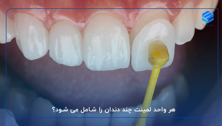 هر واحد لمینت چند دندان است