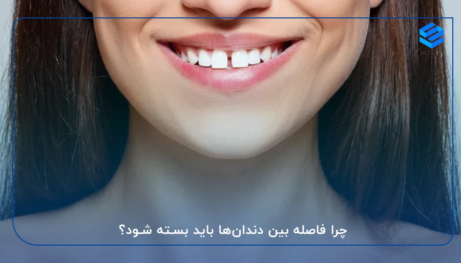 چرا فاصله بین دندان‌ها باید بسته شود؟