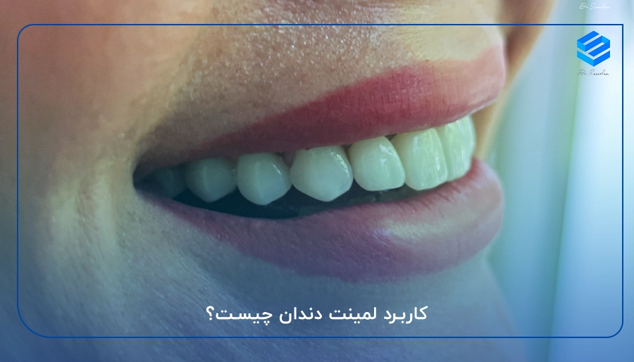 کاربرد لمینت دندان چیست؟