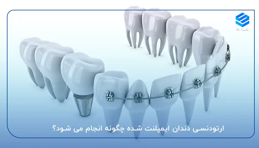 ارتودنسی دندان ایمپلنت شده