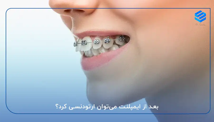 بعد از ایمپلنت می‌توان ارتودنسی کرد؟