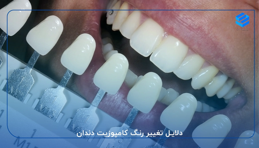 دلایل تغییر رنگ کامپوزیت دندان