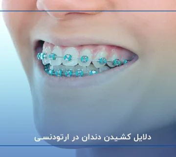دلایل کشیدن دندان در ارتودنسی