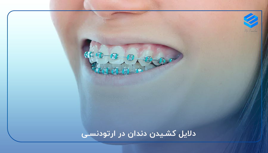 دلایل کشیدن دندان در ارتودنسی
