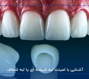 لمینت شیشه‌ای دندان