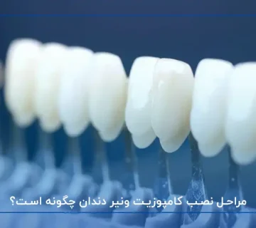 مراحل انجام کامپوزیت دندان
