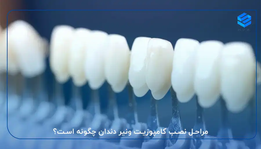 مراحل انجام کامپوزیت دندان