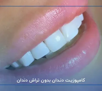 کامپوزیت دندان بدون تراش دندان