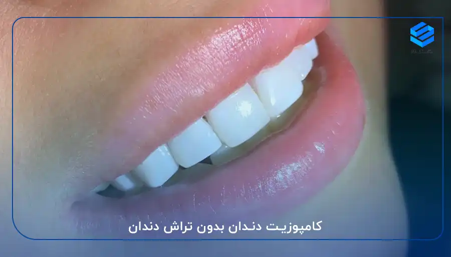 کامپوزیت دندان بدون تراش دندان
