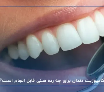 سن مناسب برای کامپوزیت دندان