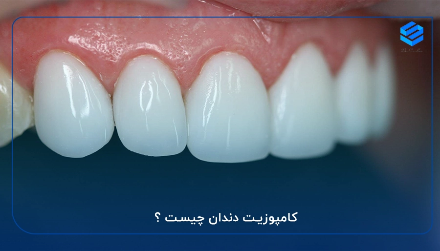 کامپوزیت دندان چیست ؟