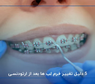 آیا ارتودنسی فرم لب را تغییر میدهد؟ ۵ دلیل تغییر فرم لب ها بعد از ارتودنسی