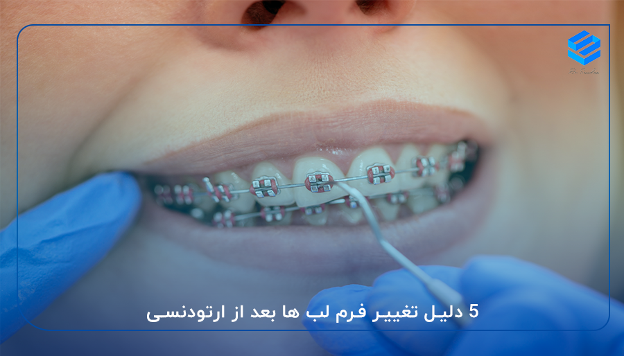 آیا ارتودنسی فرم لب را تغییر میدهد؟ ۵ دلیل تغییر فرم لب ها بعد از ارتودنسی