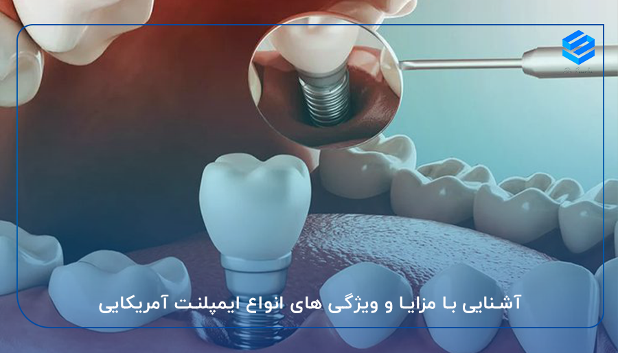 آشنایی با مزایا و ویژگی های انواع ایمپلنت آمریکایی