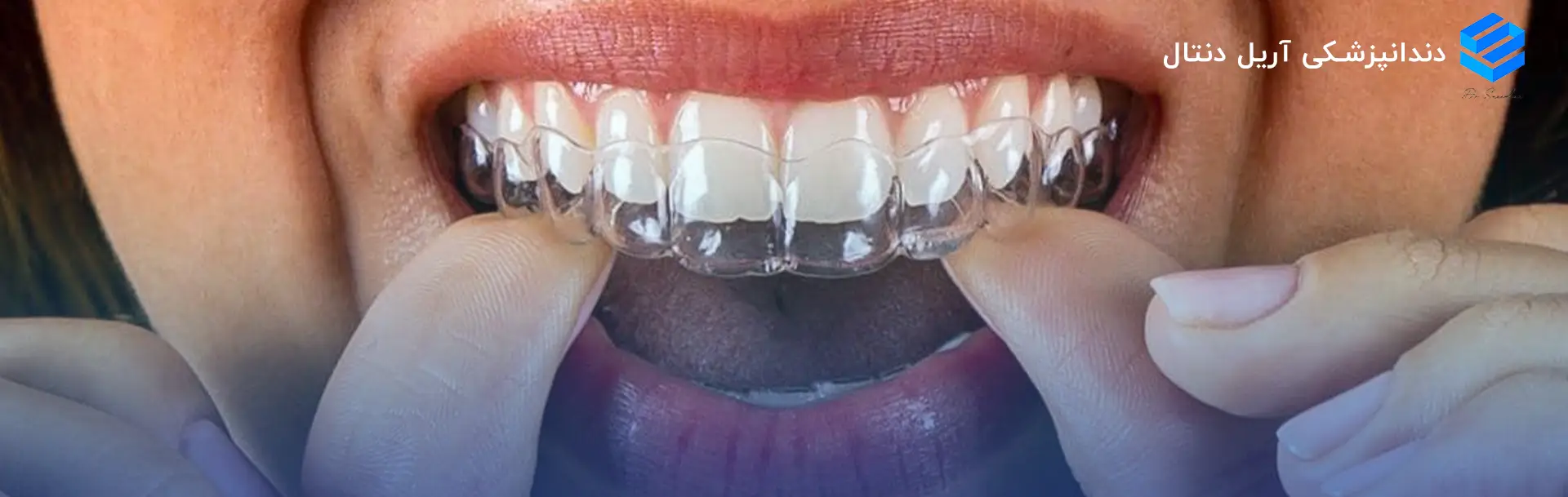 ارتودنسی شفاف