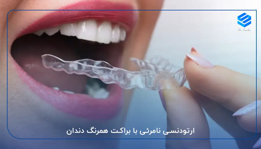 ارتودنسی نامرئی با براکت همرنگ دندان