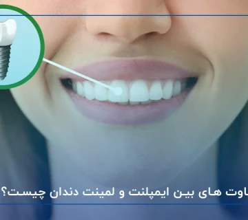 تفاوت های بین ایمپلنت و لمینت دندان چیست؟