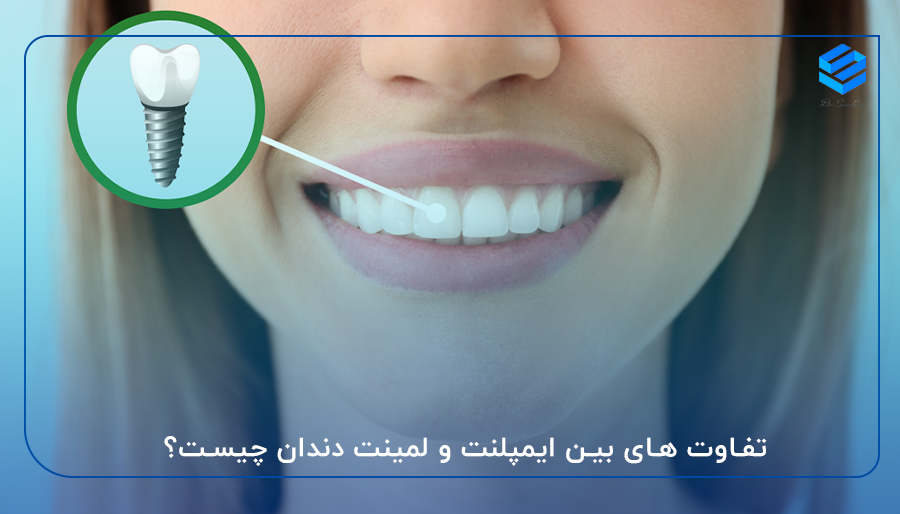 تفاوت های بین ایمپلنت و لمینت دندان چیست؟