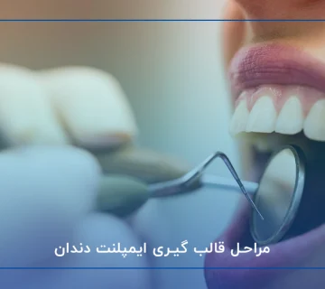مراحل قالب گیری ایمپلنت دندان