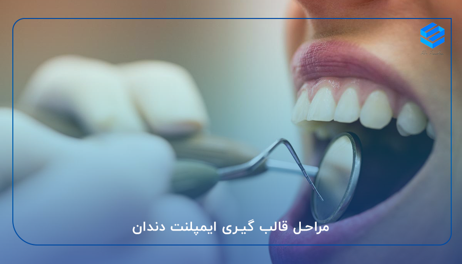 مراحل قالب گیری ایمپلنت دندان