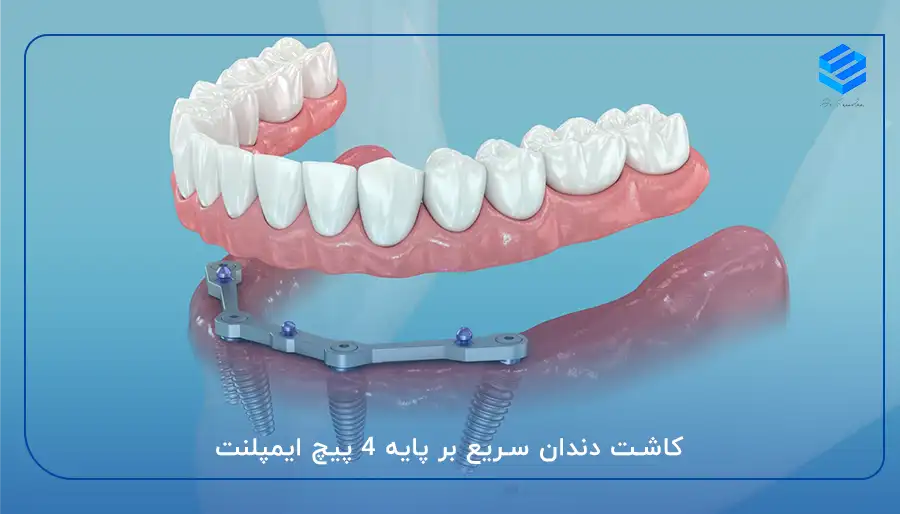 کاشت دندان سریع بر پایه 4 پیچ ایمپلنت