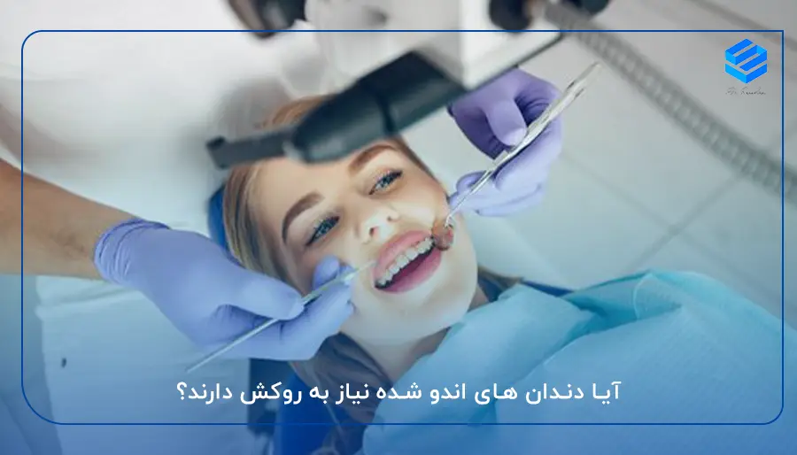 آیا دندان های اندو شده نیاز به روکش دارند؟