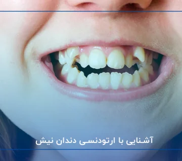 آشنایی با ارتودنسی دندان نیش
