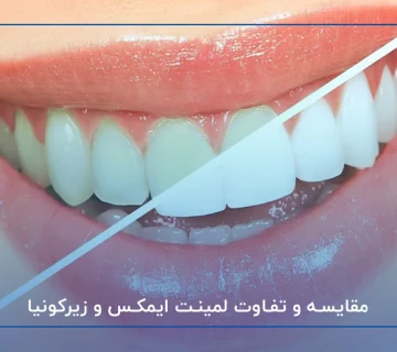 مقایسه و تفاوت لمینت ایمکس و زیرکونیا