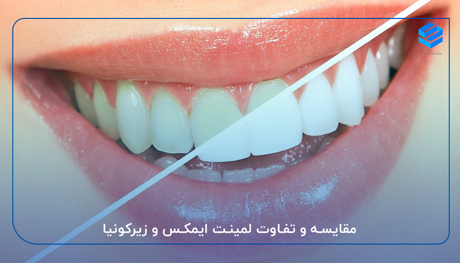 مقایسه و تفاوت لمینت ایمکس و زیرکونیا