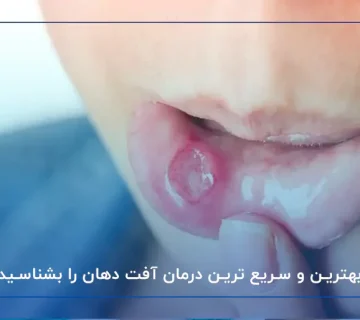 بهترین و سریع ترین درمان آفت دهان را بشناسید