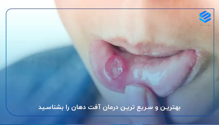 بهترین و سریع ترین درمان آفت دهان را بشناسید