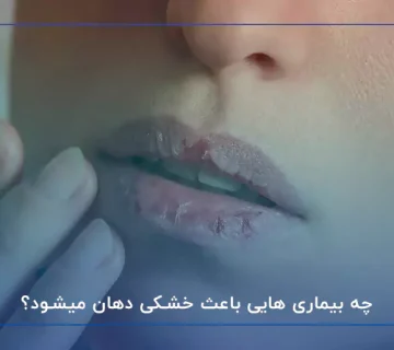 چه بیماری هایی باعث خشکی دهان میشود؟